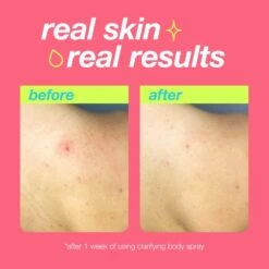 Dermalogica Clear Start Clarifying Bacne Body Spray For Acne-Prone Body Skin 177ml -JUSTMYLOOK Sales clear start clarifying bacne body spray for acne prone body skin 177ml p33599 96287 image