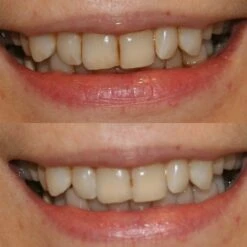 Professional Teeth Whitening Kit -JUSTMYLOOK Sales professional teeth whitening kit p17007 42558 image